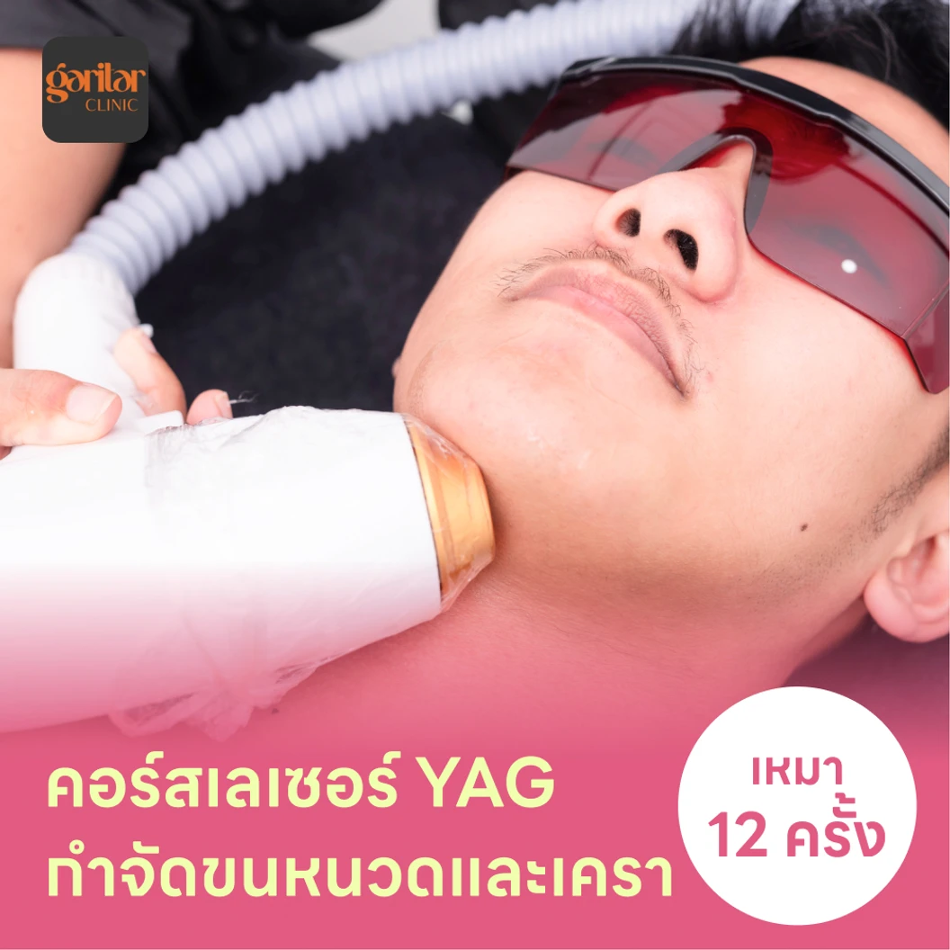 คอร์สเลเซอร์กำจัดขนหนวดและเครา 12 ครั้ง ด้วย YAG Laser