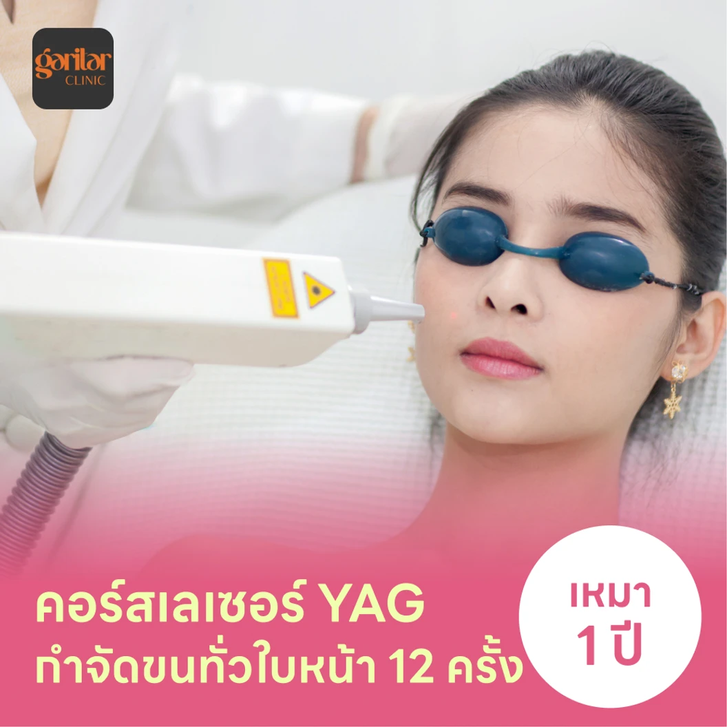 คอร์สเลเซอร์กำจัดขนทั่วหน้า 12 ครั้ง ด้วย YAG Laser