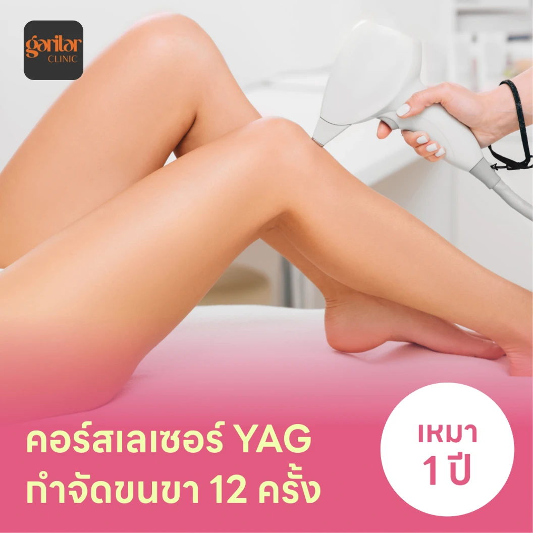 คอร์สเลเซอร์กำจัดขนขา 12 ครั้ง ด้วย YAG Laser