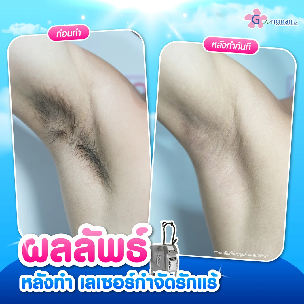 คอร์สเลเซอร์กำจัดขนรักแร้ 4 พลังงาน เครื่องแท้ Primelase จากสเปน 6 ครั้ง ภายใน 1 ปี (1 สิทธิ์/ท่าน)