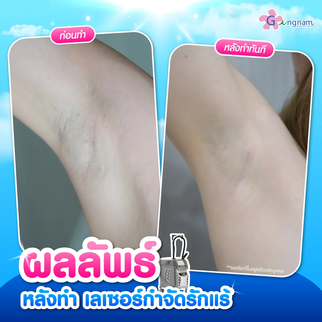 คอร์สเลเซอร์กำจัดขนรักแร้ 4 พลังงาน เครื่องแท้ Primelase จากสเปน 6 ครั้ง ภายใน 1 ปี (1 สิทธิ์/ท่าน)