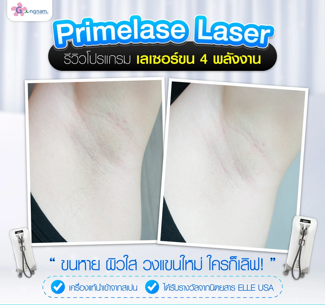 คอร์สเลเซอร์กำจัดขนรักแร้ 4 พลังงาน เครื่องแท้ Primelase จากสเปน 6 ครั้ง ภายใน 1 ปี (1 สิทธิ์/ท่าน)