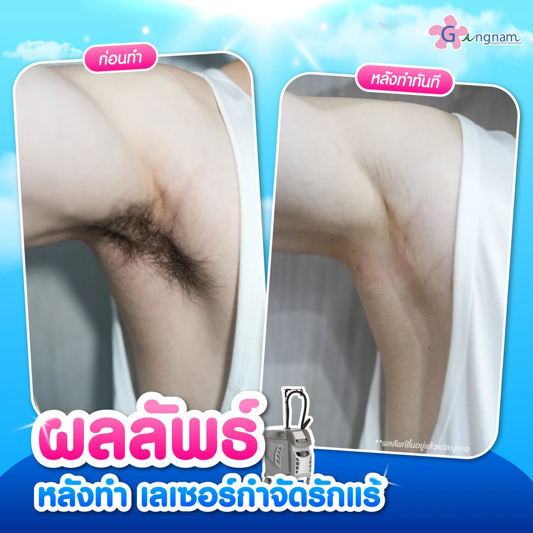 คอร์สเลเซอร์กำจัดขนรักแร้ 4 พลังงาน เครื่องแท้ Primelase จากสเปน 12 ครั้ง ภายใน 1 ปี (1 สิทธิ์/ท่าน)