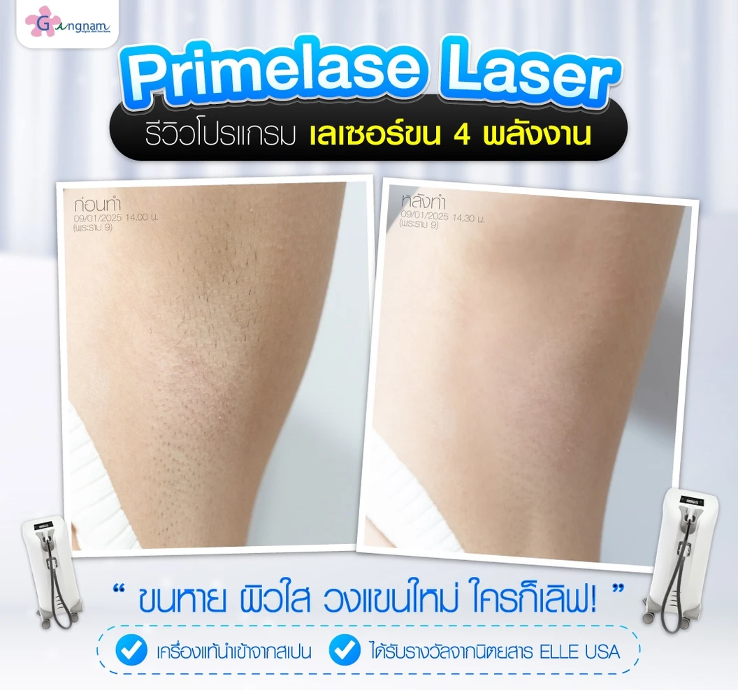 เลเซอร์กำจัดขนรักแร้ 4 พลังงาน เครื่องแท้ Primelase จากสเปน 1 ครั้ง (1 สิทธิ์/ท่าน)