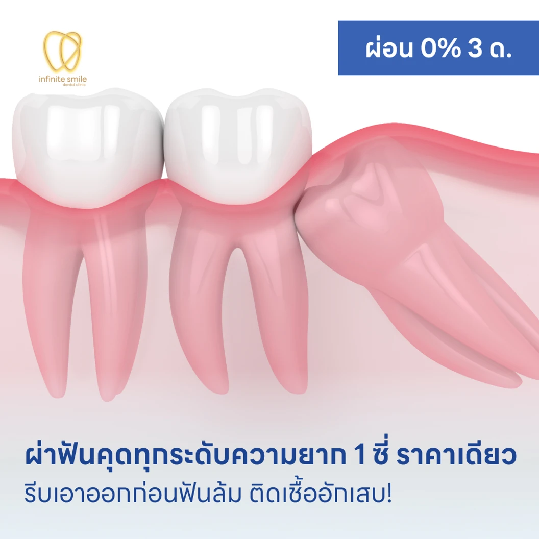 ผ่าฟันคุดทุกระดับความยาก 1 ซี่ ราคาเดียว