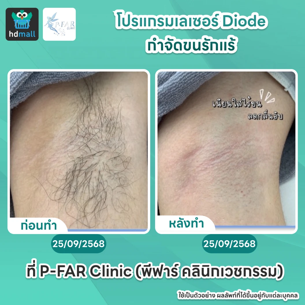 โปรแกรมเลเซอร์ Diode กำจัดขนรักแร้ 6 ครั้ง