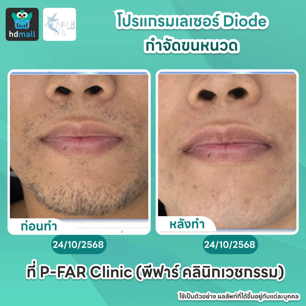 โปรแกรมเลเซอร์ Diode กำจัดขนหนวด 6 ครั้ง