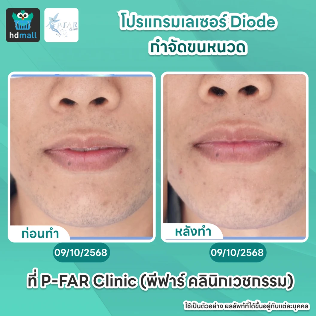 โปรแกรมเลเซอร์ Diode กำจัดขนหนวด 6 ครั้ง