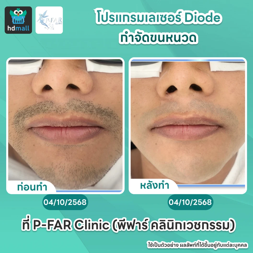 โปรแกรมเลเซอร์ Diode กำจัดขนหนวด 6 ครั้ง