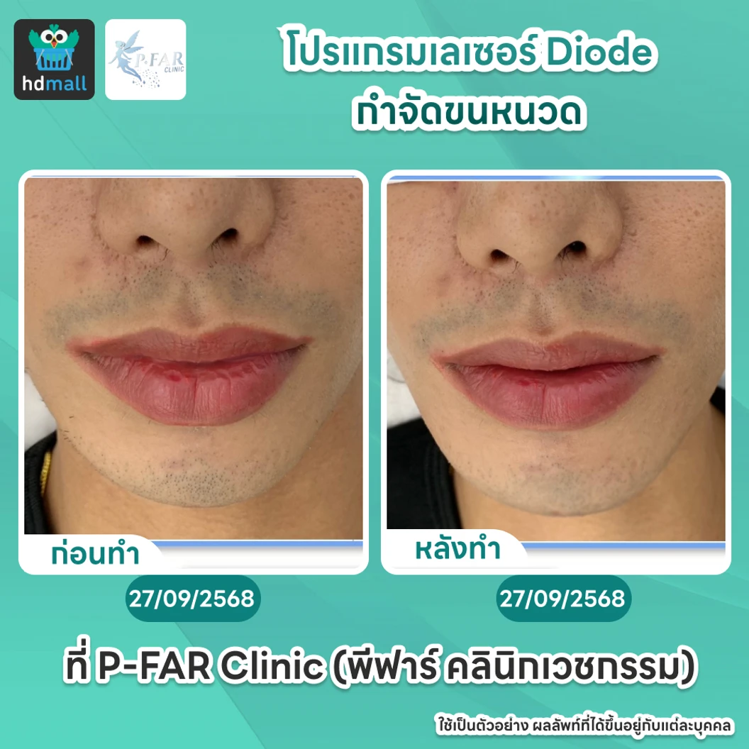 โปรแกรมเลเซอร์ Diode กำจัดขนหนวด 6 ครั้ง