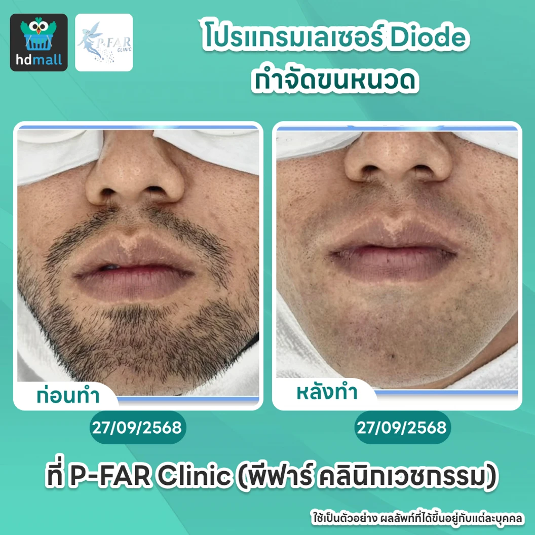 โปรแกรมเลเซอร์ Diode กำจัดขนหนวด 6 ครั้ง