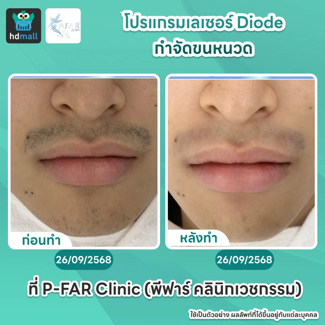 โปรแกรมเลเซอร์ Diode กำจัดขนหนวด 6 ครั้ง