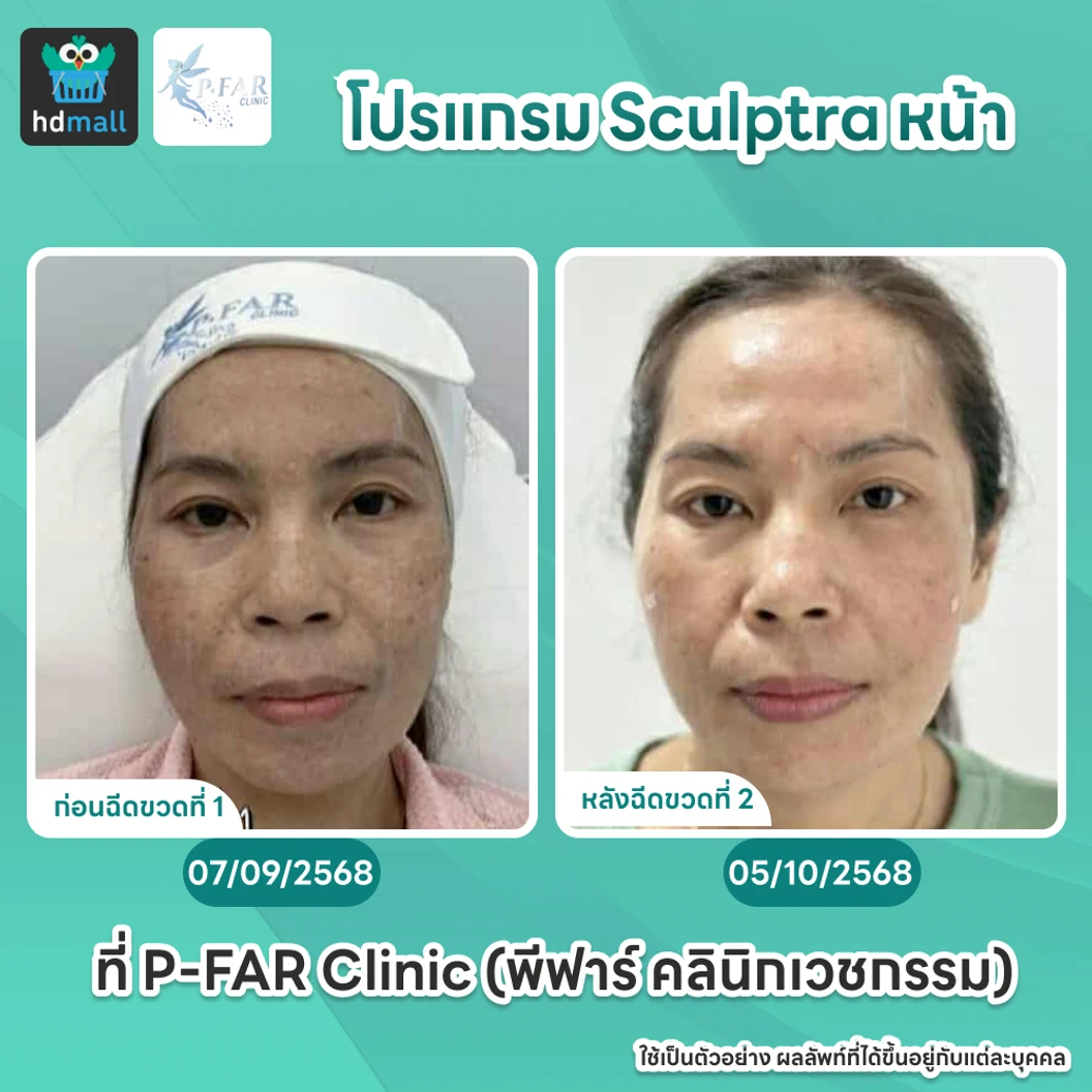 โปรแกรม Sculptra หน้า 1 ขวด (10 ซีซี)