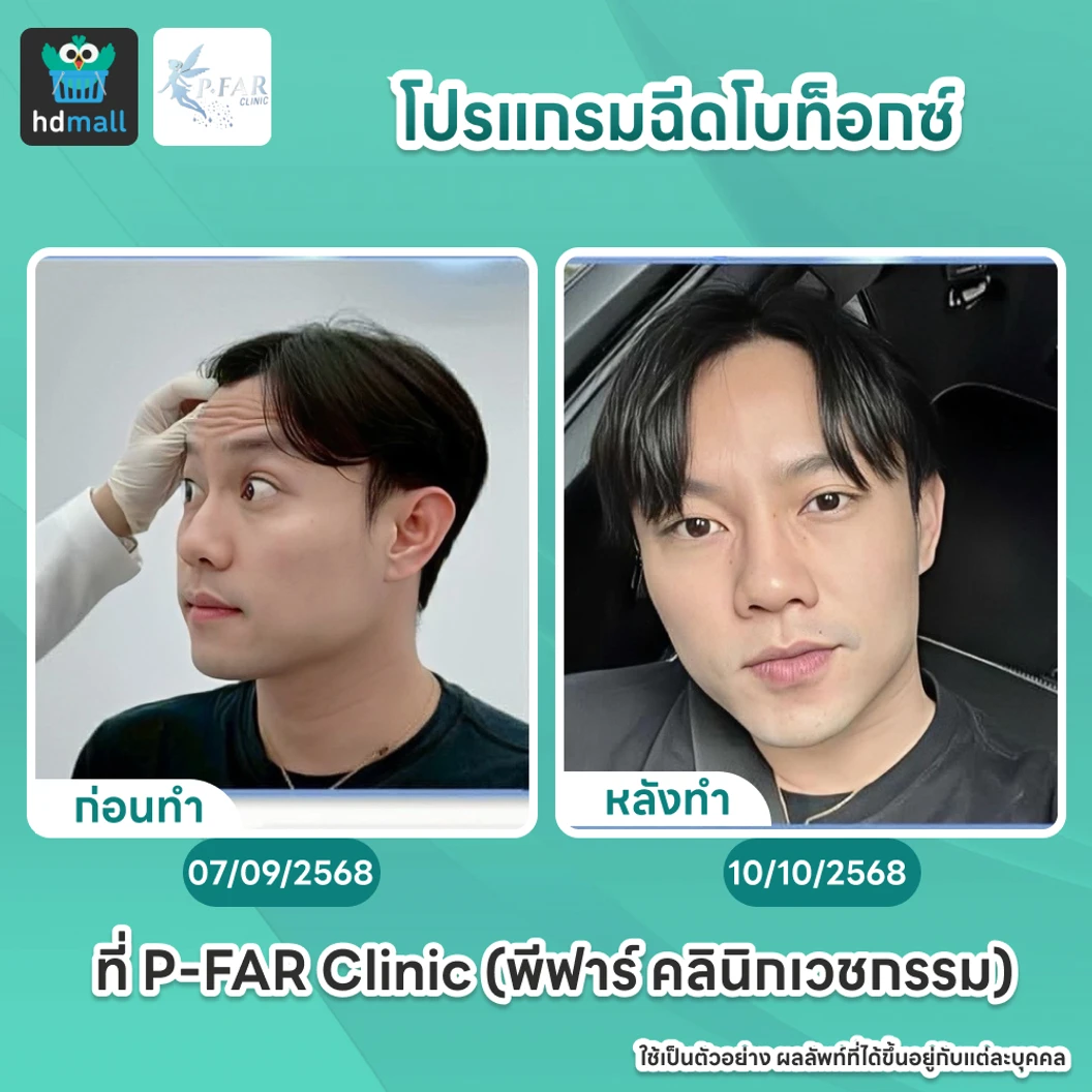 โปรแกรมฉีดโบท็อกซ์ 100 ยูนิต (หน้า)