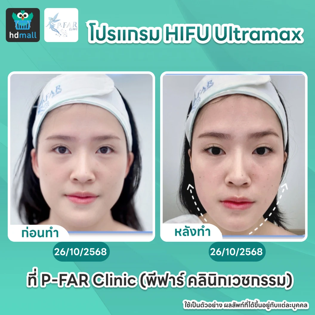 โปรแกรม HIFU Ultramax จำนวนช็อตขึ้นอยู่กับแพทย์ประเมิน (ทั่วหน้า)