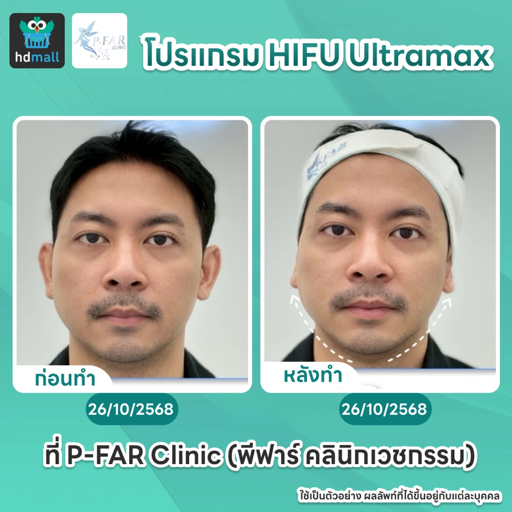 โปรแกรม HIFU Ultramax จำนวนช็อตขึ้นอยู่กับแพทย์ประเมิน (ทั่วหน้า)