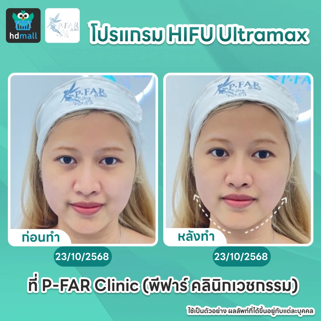 โปรแกรม HIFU Ultramax จำนวนช็อตขึ้นอยู่กับแพทย์ประเมิน (ทั่วหน้า)