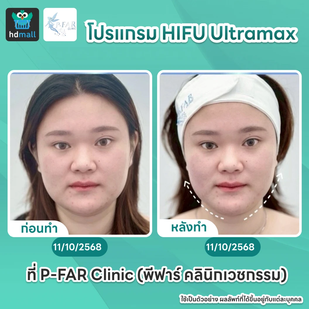 โปรแกรม HIFU Ultramax จำนวนช็อตขึ้นอยู่กับแพทย์ประเมิน (ทั่วหน้า)