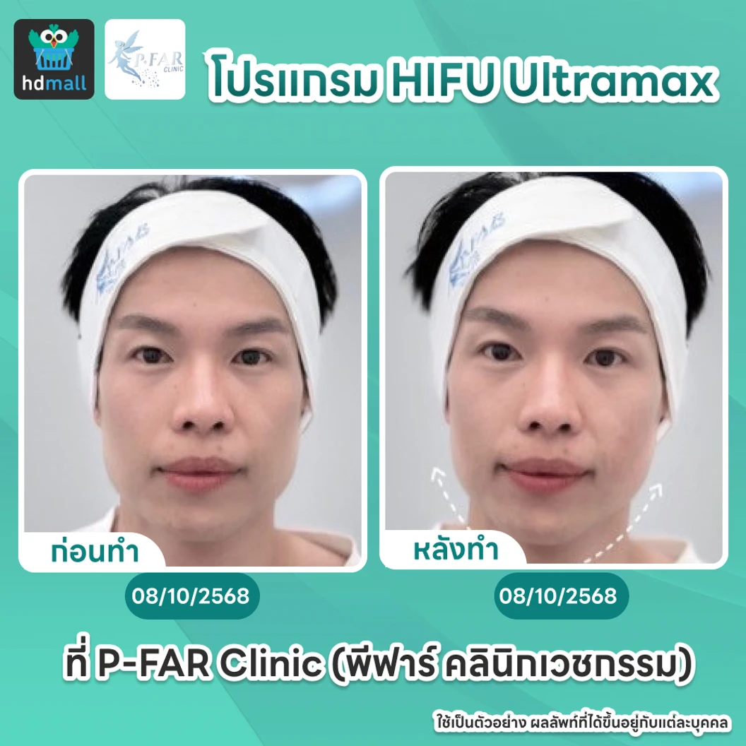 โปรแกรม HIFU Ultramax จำนวนช็อตขึ้นอยู่กับแพทย์ประเมิน (ทั่วหน้า)