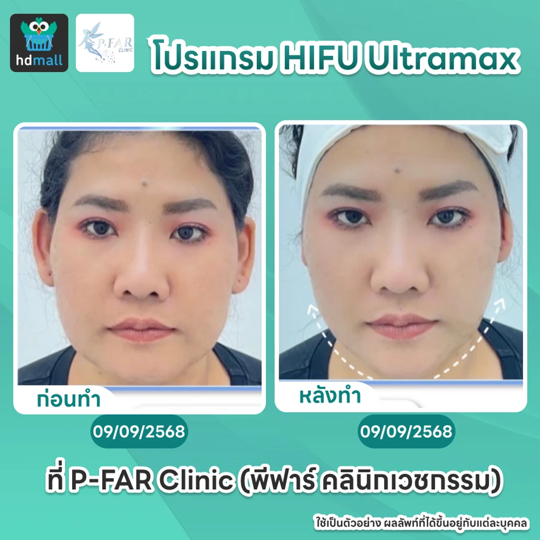 โปรแกรม HIFU Ultramax จำนวนช็อตขึ้นอยู่กับแพทย์ประเมิน (ทั่วหน้า)