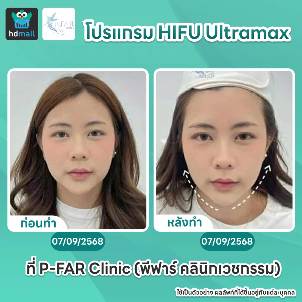 โปรแกรม HIFU Ultramax จำนวนช็อตขึ้นอยู่กับแพทย์ประเมิน (ทั่วหน้า)