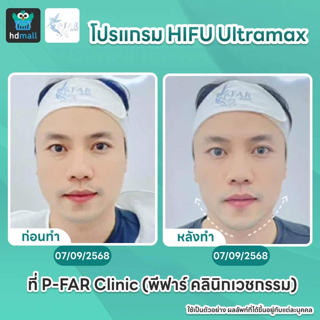 โปรแกรม HIFU Ultramax จำนวนช็อตขึ้นอยู่กับแพทย์ประเมิน (ทั่วหน้า)