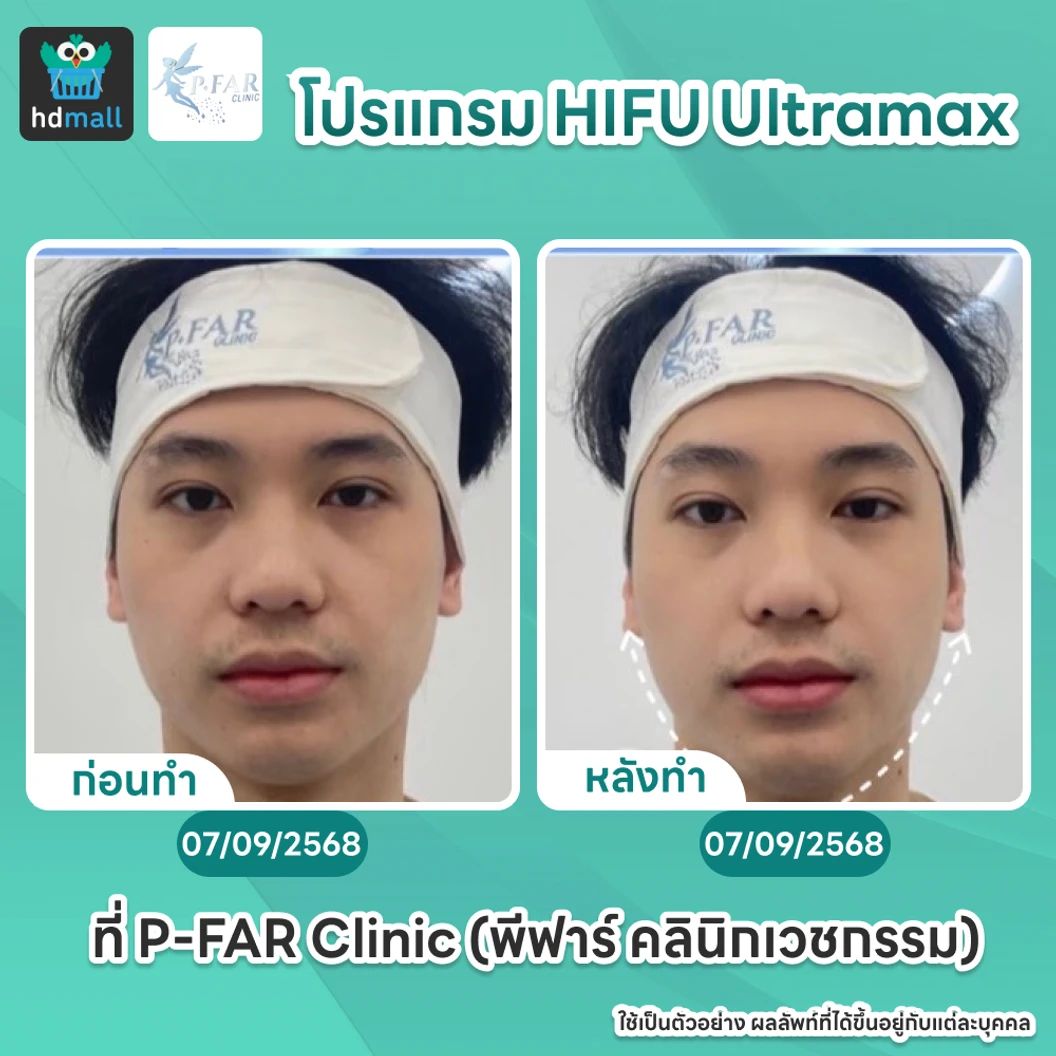 โปรแกรม HIFU Ultramax จำนวนช็อตขึ้นอยู่กับแพทย์ประเมิน (ทั่วหน้า)