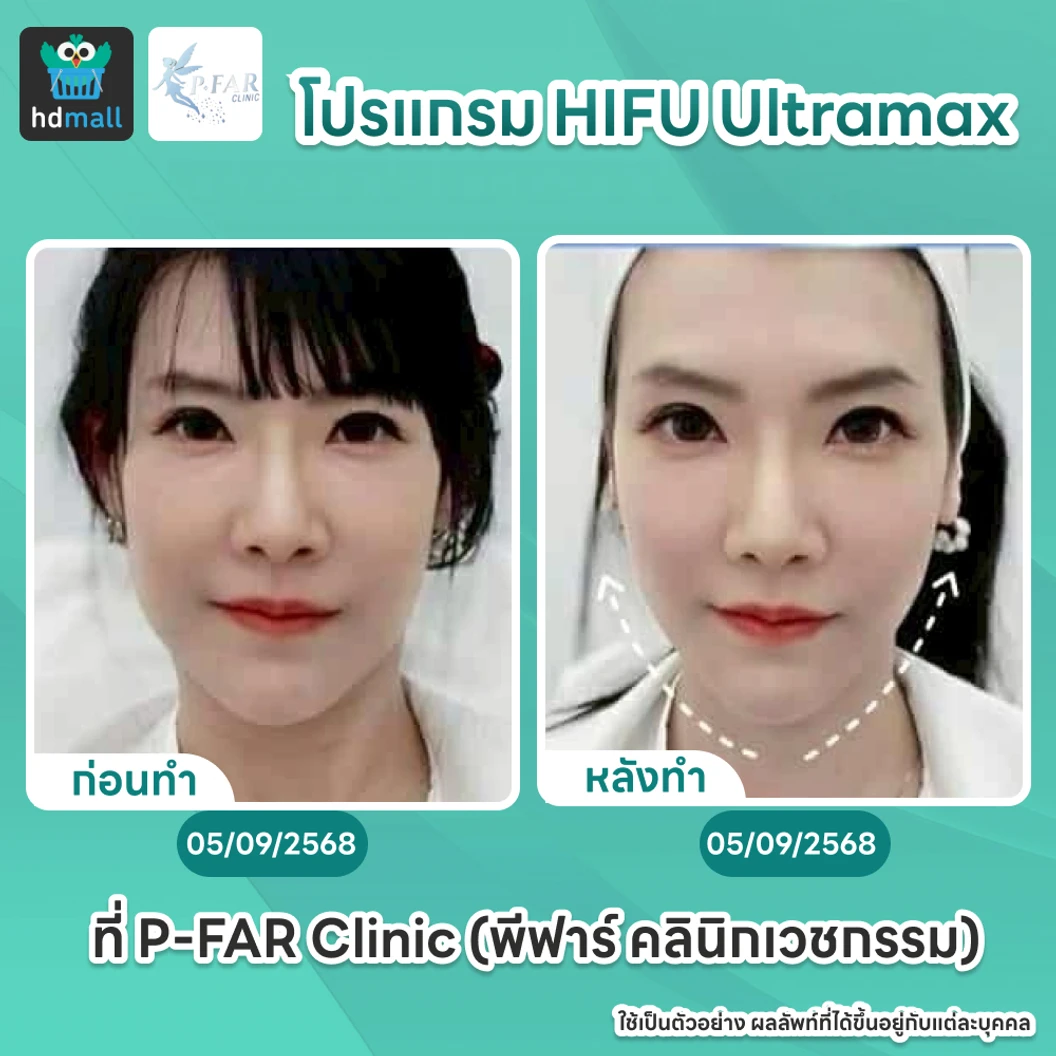โปรแกรม HIFU Ultramax จำนวนช็อตขึ้นอยู่กับแพทย์ประเมิน (ทั่วหน้า)
