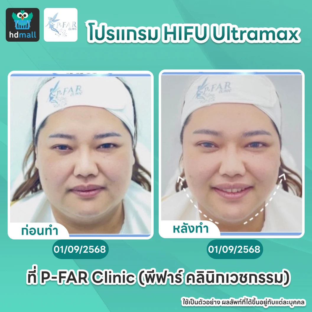 โปรแกรม HIFU Ultramax จำนวนช็อตขึ้นอยู่กับแพทย์ประเมิน (ทั่วหน้า)