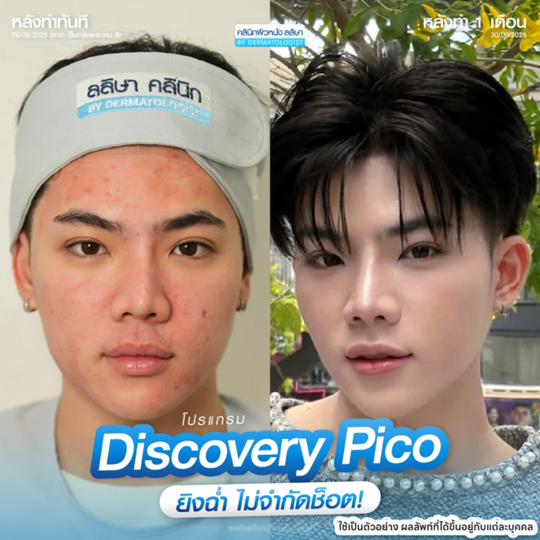 Picosecond Laser แก้ปัญหาผิวทั่วใบหน้า 1 ครั้ง จำกัด 1 ท่านต่อ 1 สิทธิ์ เท่านั้น
