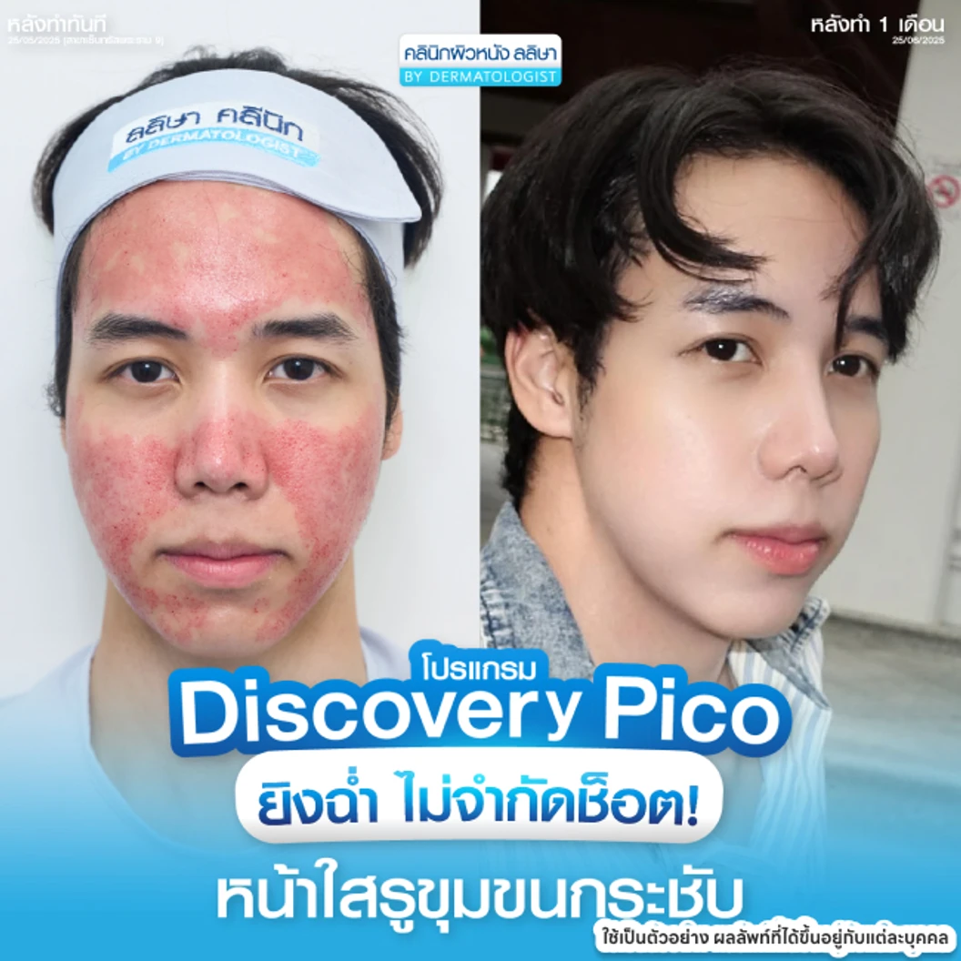 Picosecond Laser แก้ปัญหาผิวทั่วใบหน้า 1 ครั้ง จำกัด 1 ท่านต่อ 1 สิทธิ์ เท่านั้น