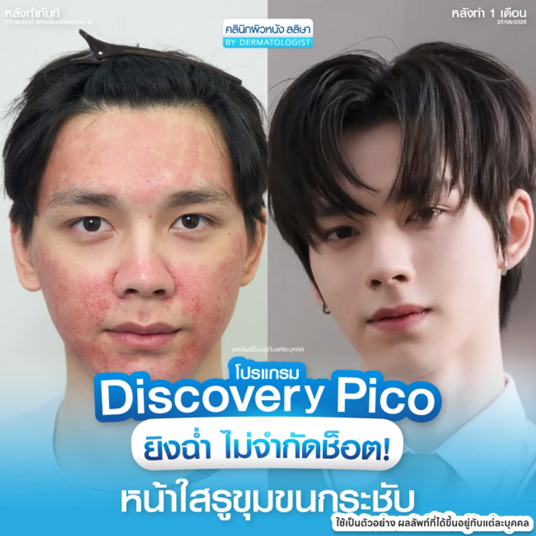 Picosecond Laser แก้ปัญหาผิวทั่วใบหน้า 1 ครั้ง จำกัด 1 ท่านต่อ 1 สิทธิ์ เท่านั้น