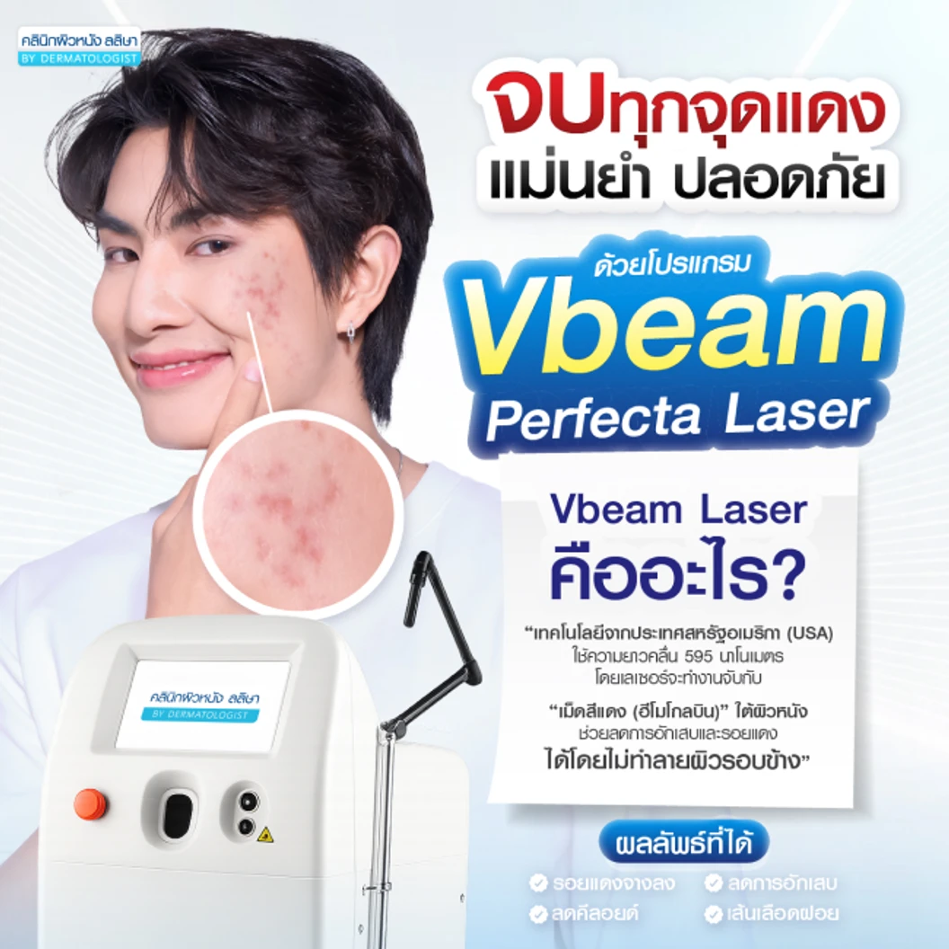 โปรแกรมเลเซอร์ Vbeam Perfecta ลดรอยแดงจากสิว 100 ช็อต