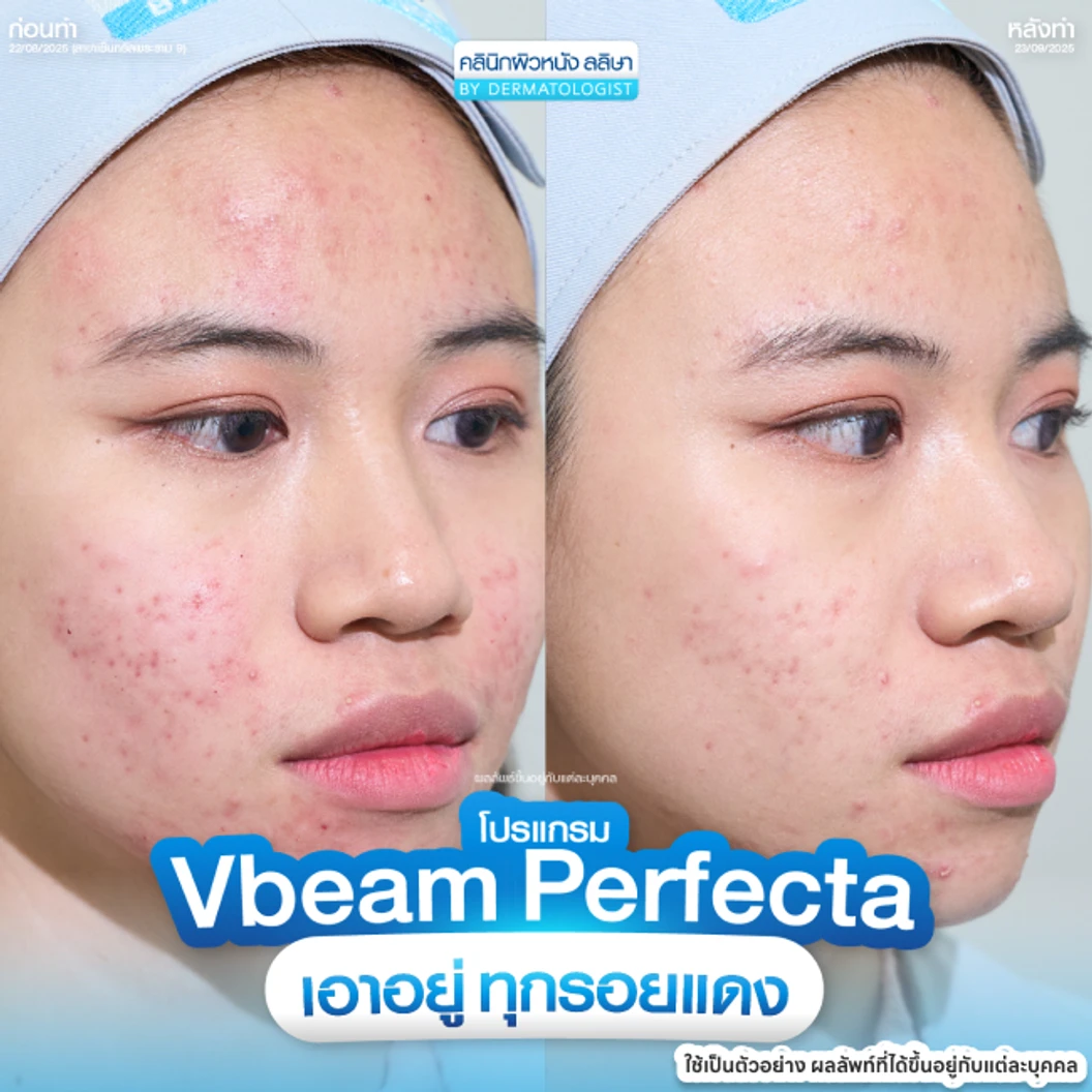 โปรแกรมเลเซอร์ Vbeam Perfecta ลดรอยแดงจากสิว 100 ช็อต