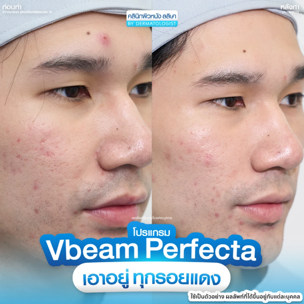 โปรแกรมเลเซอร์ Vbeam Perfecta ลดรอยแดงจากสิว 100 ช็อต