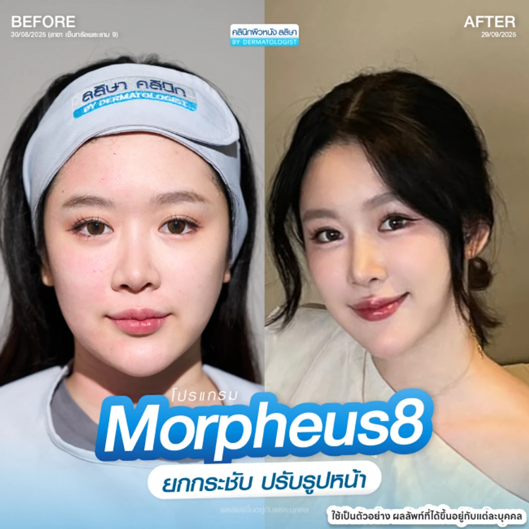 โปรแกรม Morpheus 8 ยกกระชับ (หน้า + คอ)