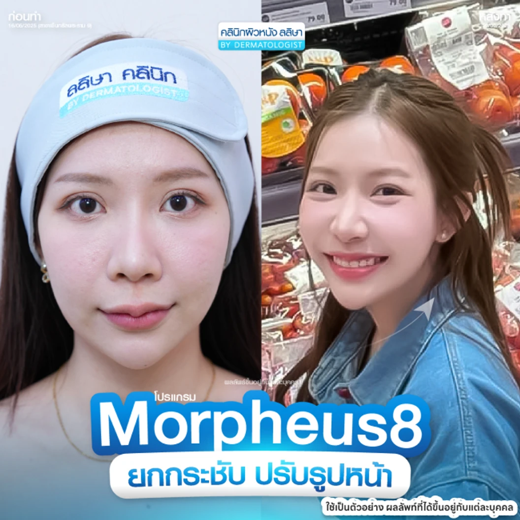 โปรแกรม Morpheus 8 ยกกระชับ (หน้า + คอ)