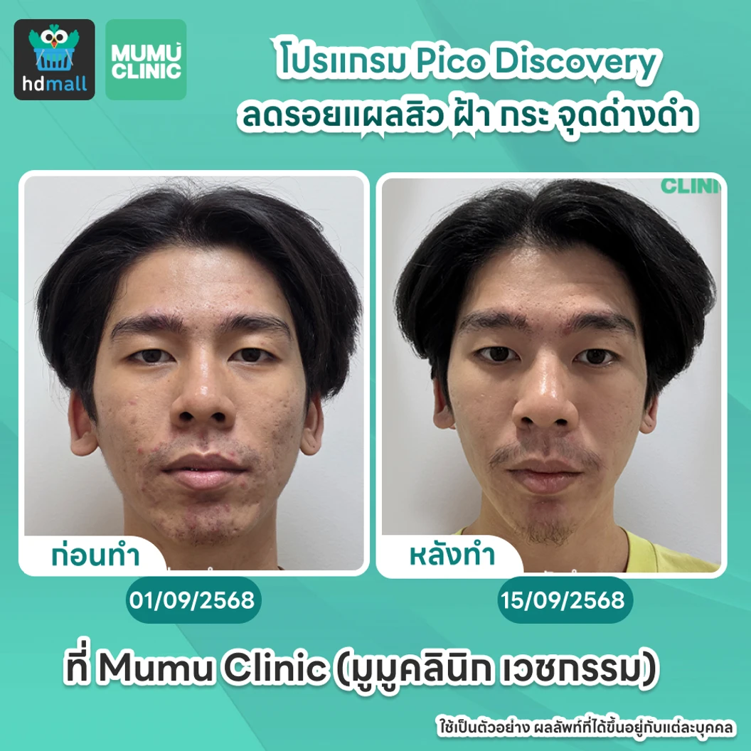 คอร์ส Picosecond Laser แก้ปัญหาผิวทั่วใบหน้า 12 ครั้ง