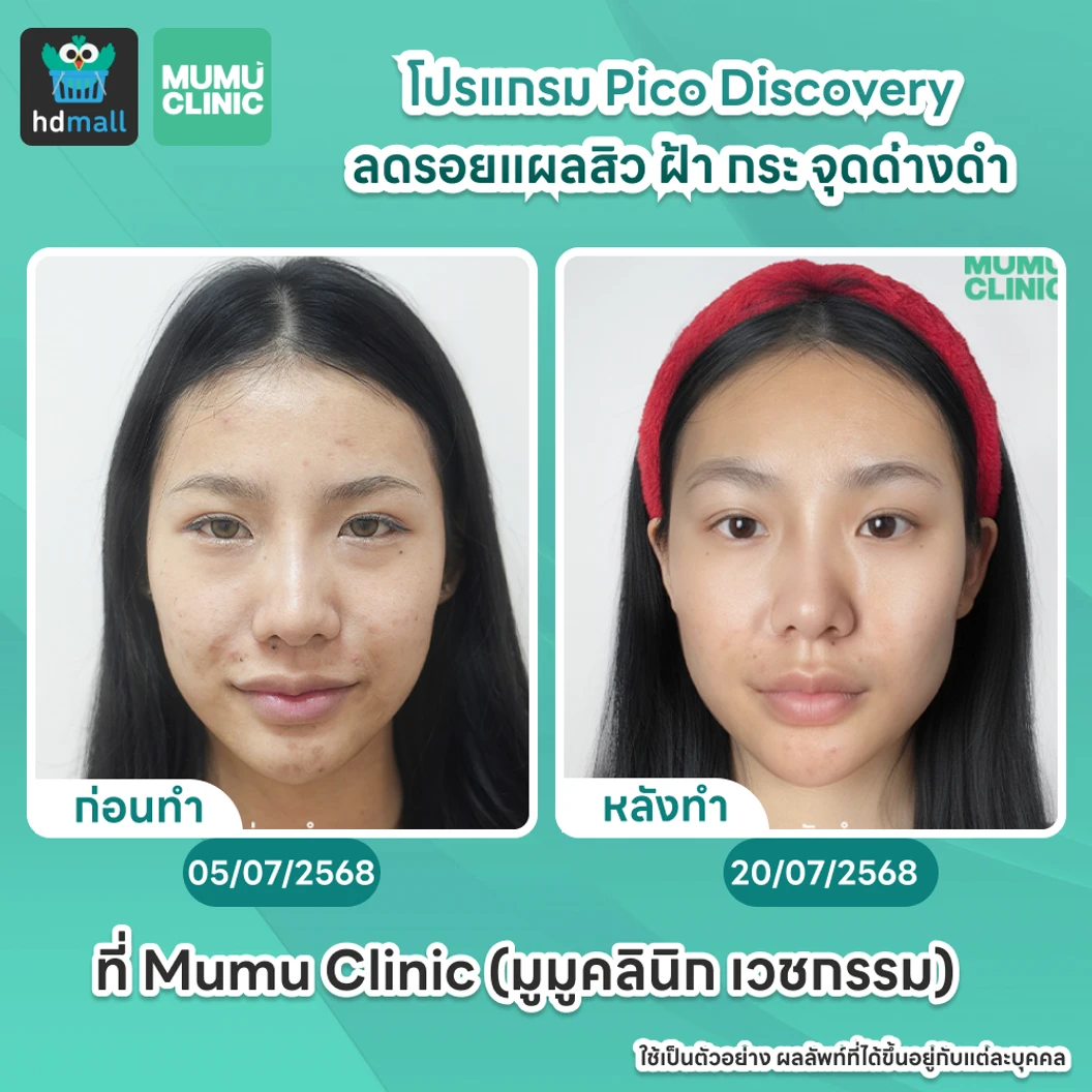 คอร์ส Picosecond Laser แก้ปัญหาผิวทั่วใบหน้า 12 ครั้ง