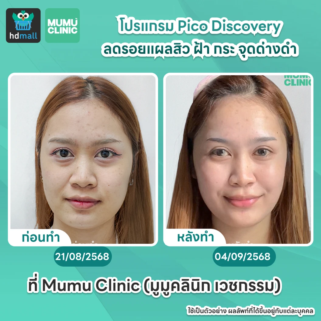 คอร์ส Picosecond Laser แก้ปัญหาผิวทั่วใบหน้า 6 ครั้ง