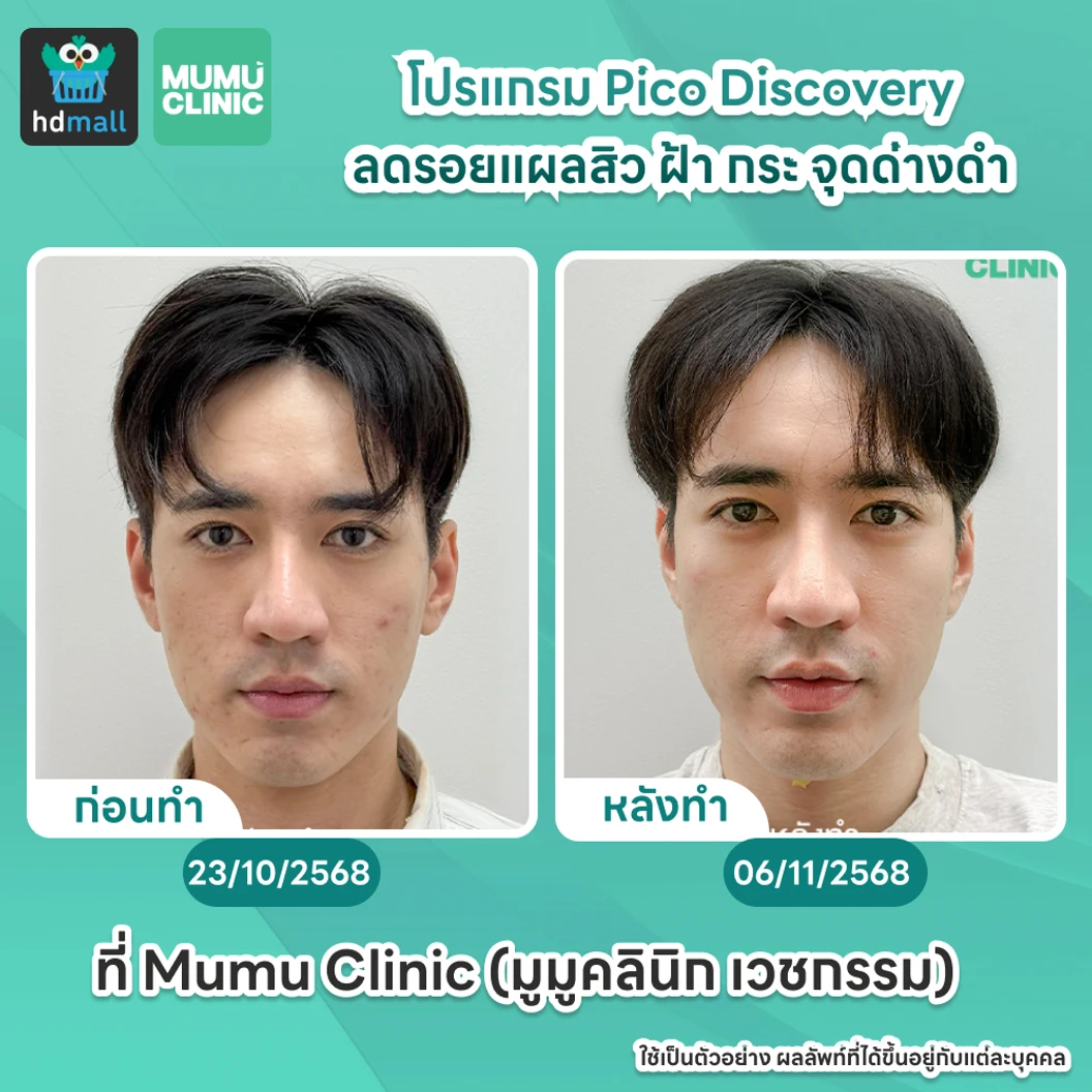Picosecond Laser แก้ปัญหาผิวทั่วใบหน้า 1 ครั้ง จำกัด 1 ท่านต่อ 1 สิทธิ์ เท่านั้น