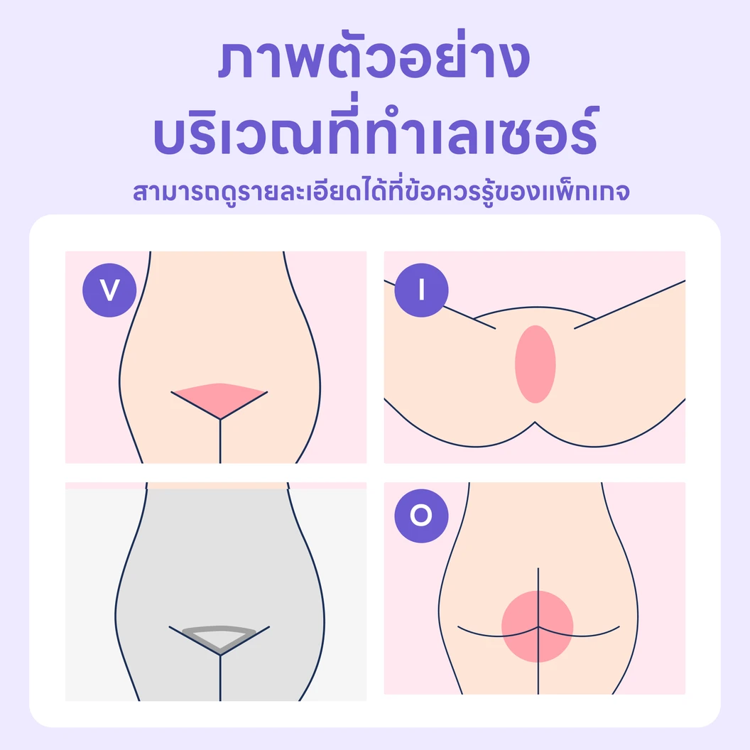 คอร์สกำจัดขน Brazilian ด้วย Diode Laser 3 ครั้ง ภายใน 3 เดือน สำหรับผู้หญิง (1 สิทธิ์/ท่าน)