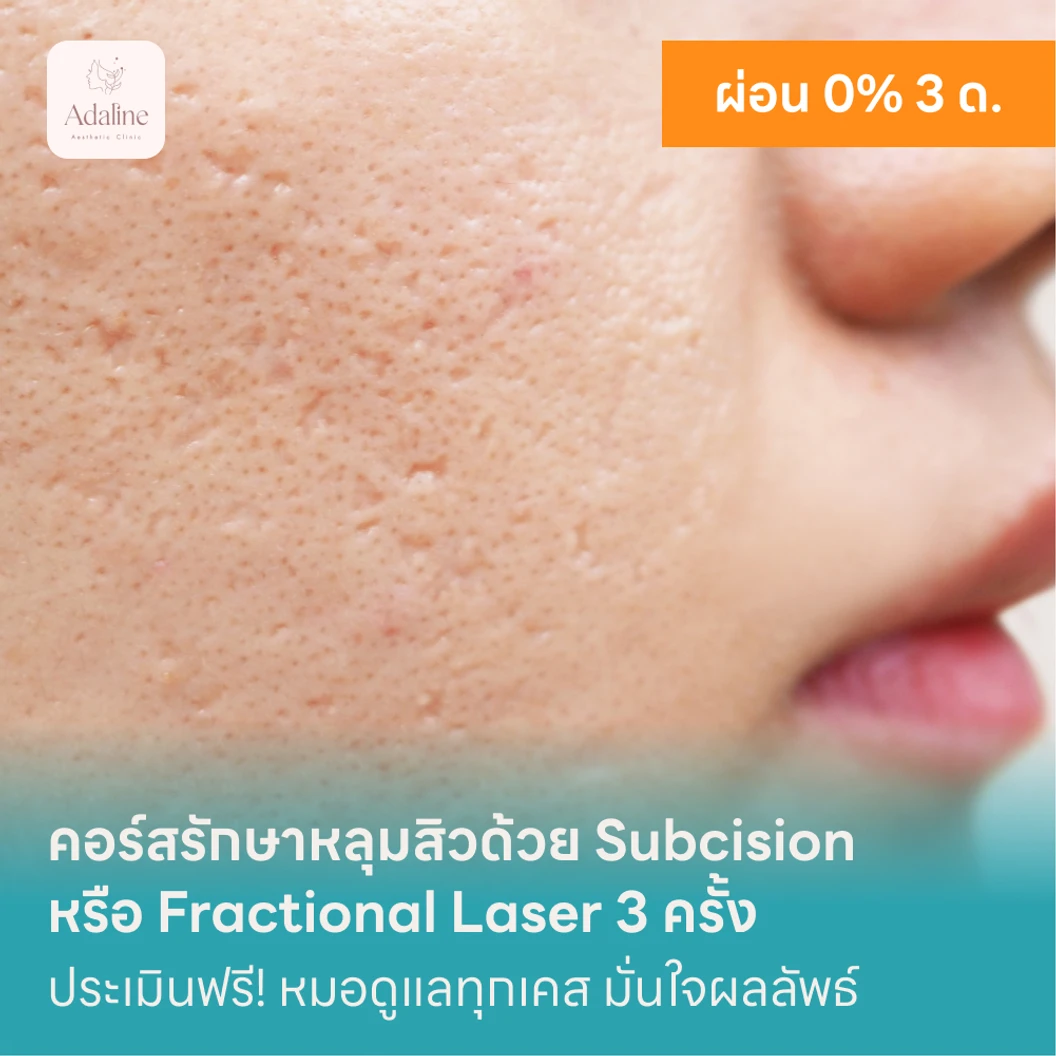 คอร์สรักษาหลุมสิวด้วย Subcision หรือ Fractional Laser 3 ครั้ง