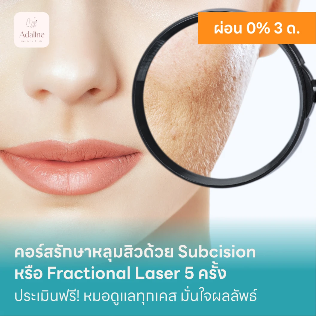 คอร์สรักษาหลุมสิวด้วย Subcision หรือ Fractional Laser 5 ครั้ง