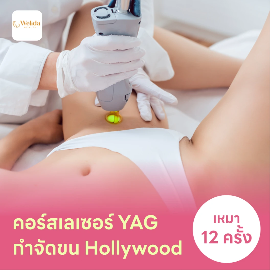 คอร์สเลเซอร์กำจัดขนน้องสาวแบบ Hollywood (vVIO) 12 ครั้ง ด้วย YAG Laser