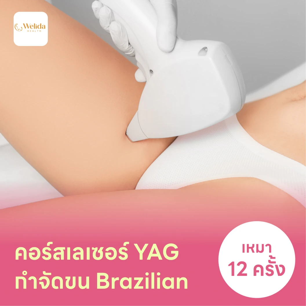 คอร์สเลเซอร์กำจัดขนน้องสาวแบบ Brazilian (vVI) 12 ครั้ง ด้วย YAG Laser