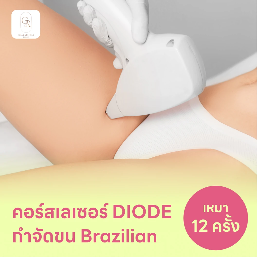 คอร์สเลเซอร์กำจัดขนน้องสาวแบบ Brazilian (vVI) 12 ครั้ง ด้วย Diode Laser