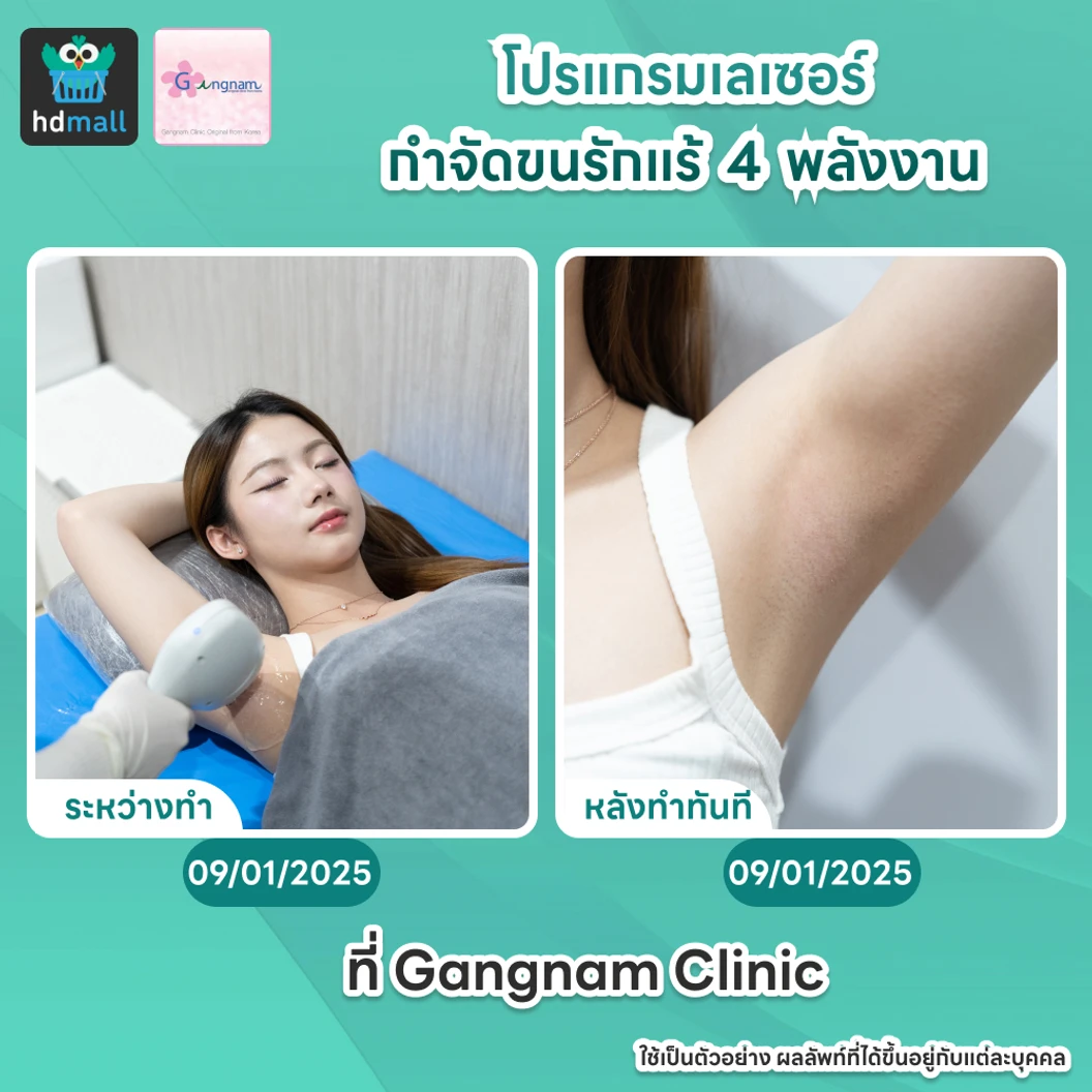 คอร์สเลเซอร์กำจัดขนรักแร้ 4 พลังงาน เครื่องแท้ Primelase จากสเปน 12 ครั้ง ภายใน 1 ปี (1 สิทธิ์/ท่าน)