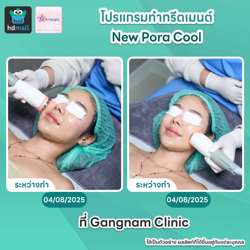 ทำทรีตเมนต์ New Pora Cool เติมวิตามินผิว ให้ผิวแข็งแรง กระจ่างใส ชุ่มชื้น รูขุมขนดูเล็กลง 1 ครั้ง