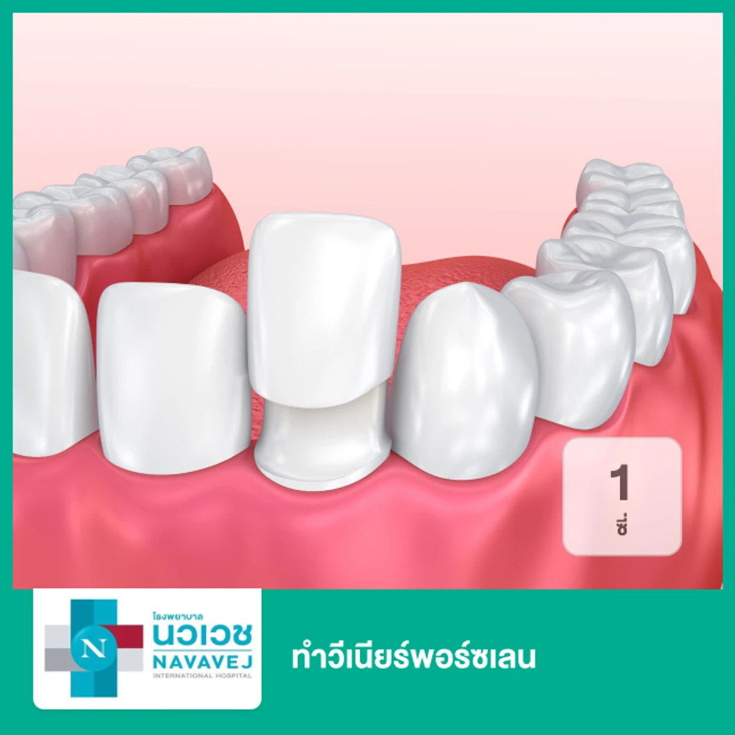 ทำวีเนียร์พอร์ซเลน 1 ซี่